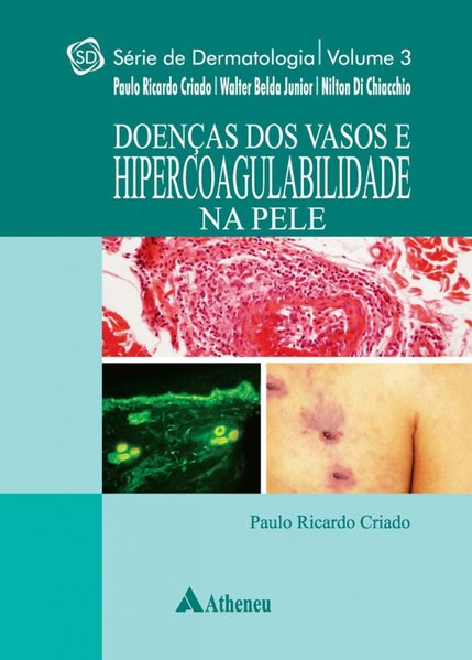 Doenças dos Vasos e Hipercoagulabilidade na Pele - Vol. 3