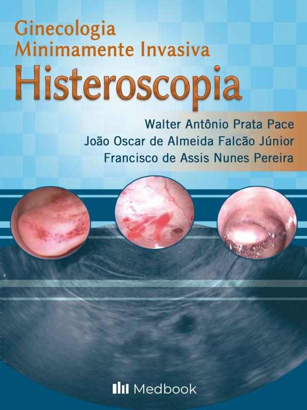 Histeroscopia - Ginecologia Minimamente Invasiva