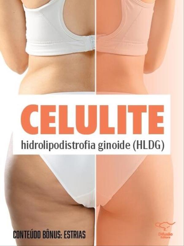 Celulite (Hidrolipodistrofia Ginoide - Hldg) e Estrias - Vol. 5